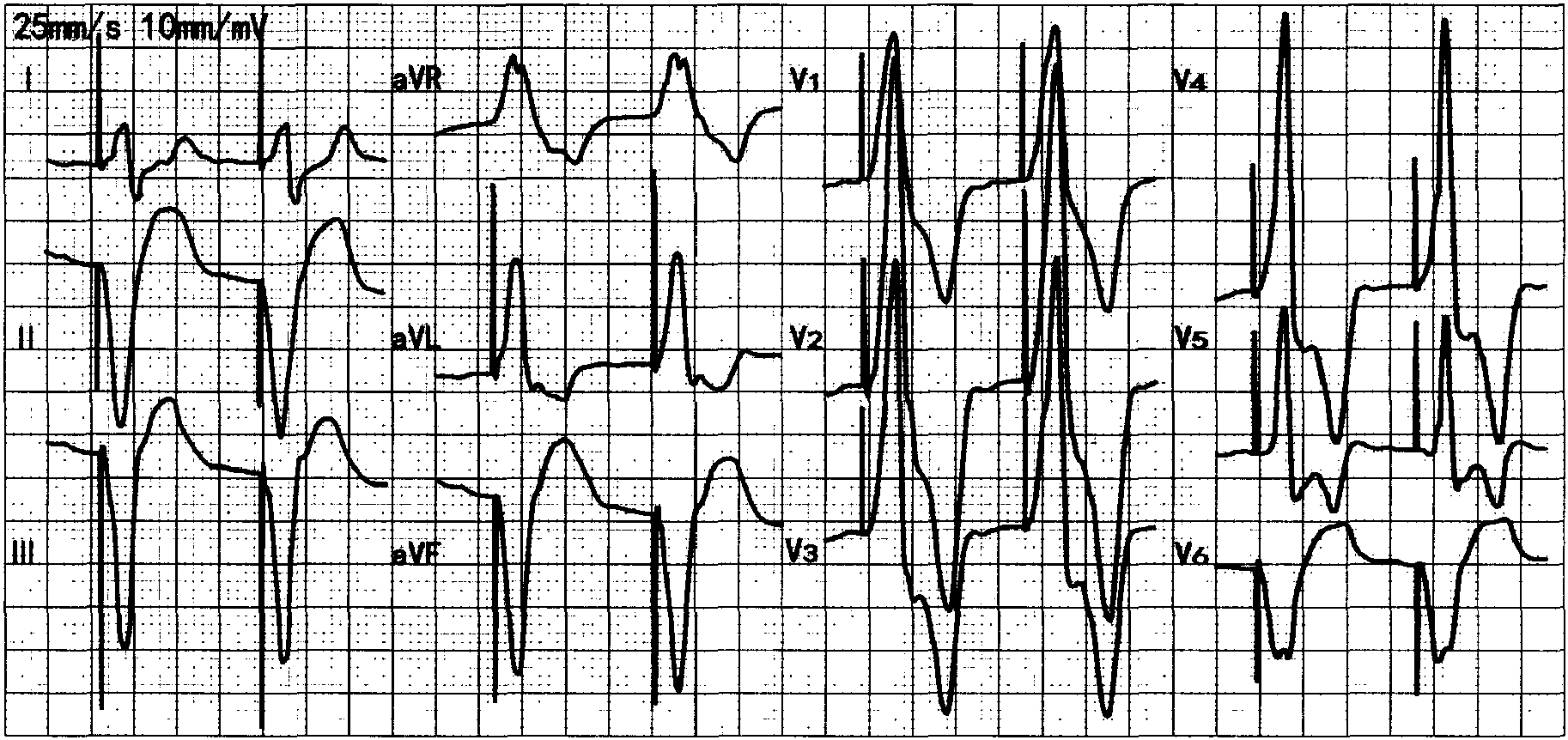 十一、左室起搏